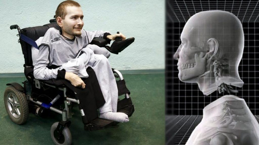Russian Man, Valery Spiridonov; The Client for First Head Transplant